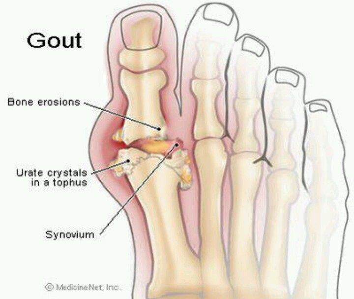 Chế độ ăn uống, kiêng kị cho người bị mắc bệnh Gout